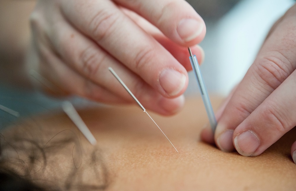 Dry Needling  Elyria, OH, 
